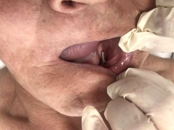 İmplant tedavisi diye gitmişti! 28 yıl sonra ortaya çıkan gerçek dehşete galerisi resim 1