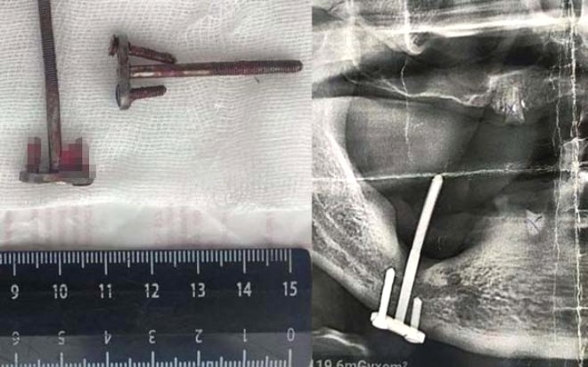 İmplant tedavisi diye gitmişti! 28 yıl sonra ortaya çıkan gerçek dehşete galerisi resim 4