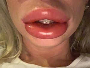 Dudaklarına dolgu yaptırmak istemişti, ölümle burun buruna geldi!