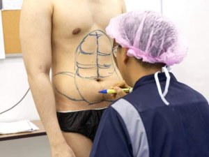 Ameliyatla karın kası (baklava) yapıyorlar