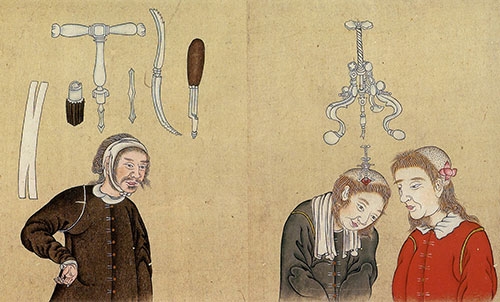 Geçmişte Kullanılan İnanılmaz Tehlikeli Tedavi Yöntemleri galerisi resim 1