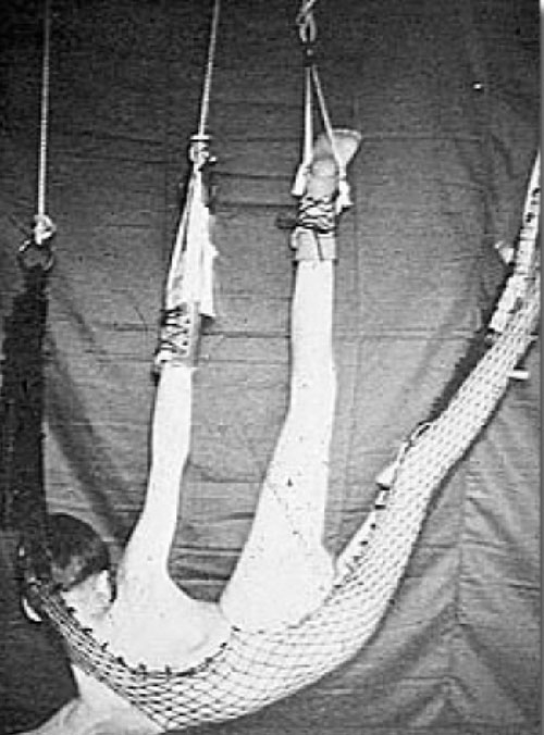 Geçmişte Kullanılan İnanılmaz Tehlikeli Tedavi Yöntemleri galerisi resim 6