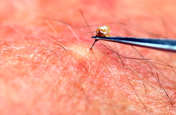 Geçmişte Kullanılan İnanılmaz Tehlikeli Tedavi Yöntemleri galerisi resim 7