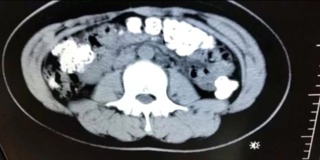 Kabızlık sebebiyle gitti, midesinden çıkanlar doktorları bile şaşırttı galerisi resim 5