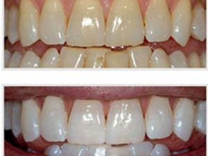 Dişleri beyazlatmanın 5 pratik yolu