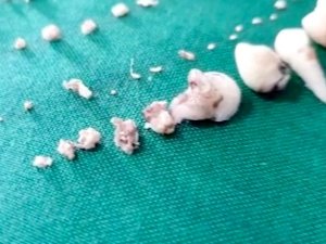 7 yaşındaki çocuğun ağzından 526 diş çıktı!