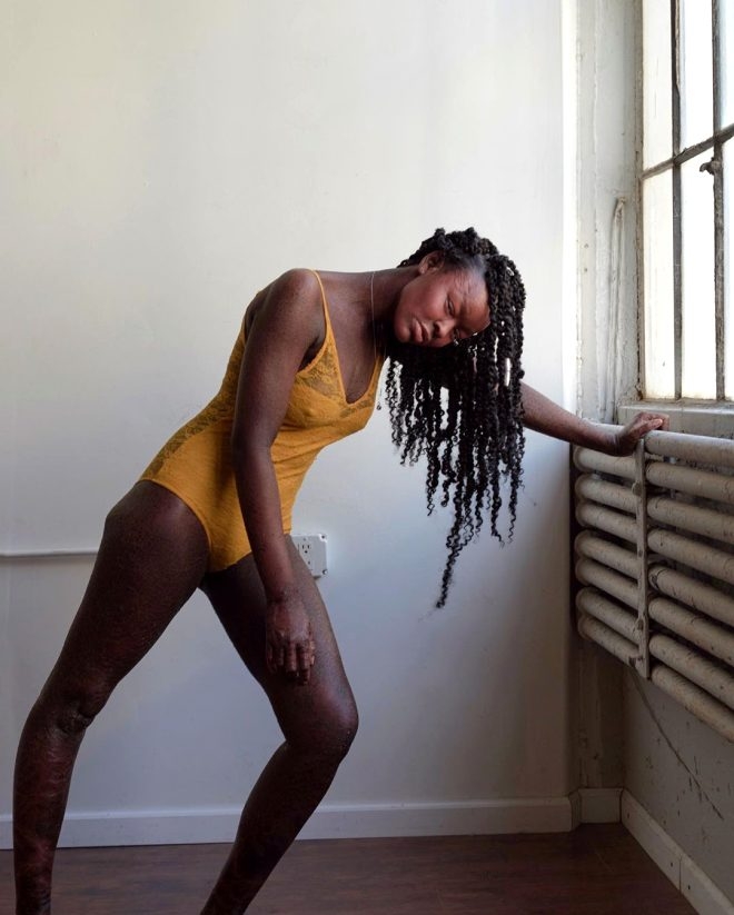 Yüz bin kişiden birinde görülüyor! Genç model, iki haftada bir deri deği galerisi resim 1