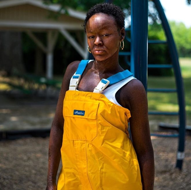 Yüz bin kişiden birinde görülüyor! Genç model, iki haftada bir deri deği galerisi resim 2