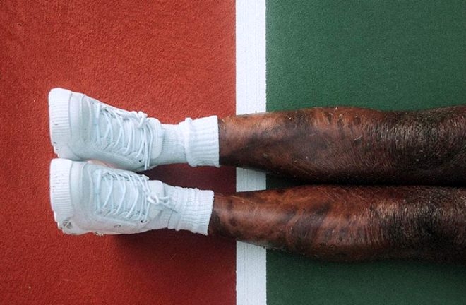 Yüz bin kişiden birinde görülüyor! Genç model, iki haftada bir deri deği galerisi resim 7