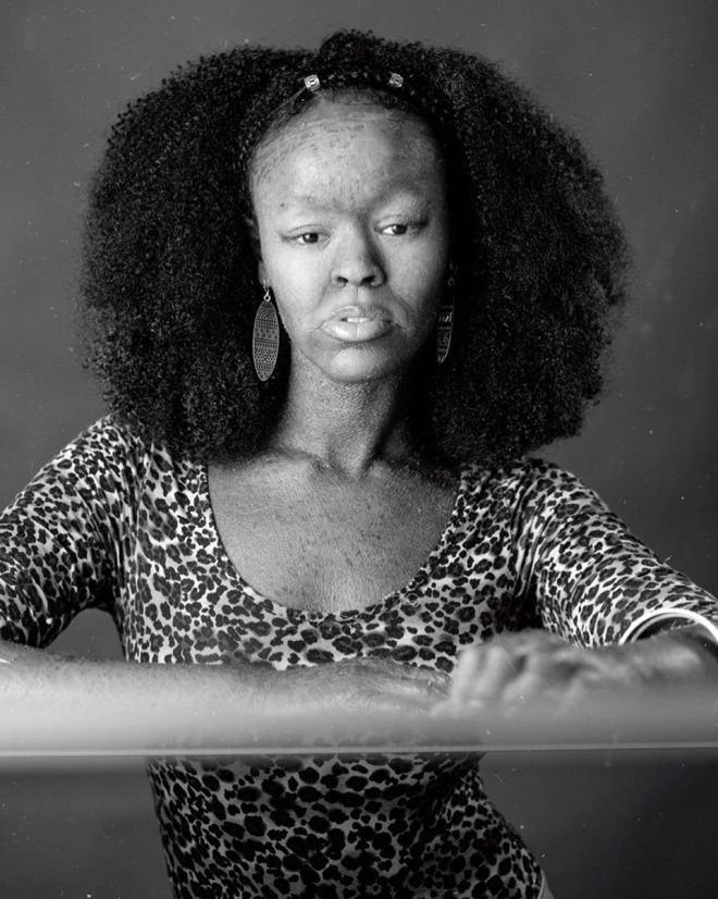 Yüz bin kişiden birinde görülüyor! Genç model, iki haftada bir deri deği galerisi resim 8