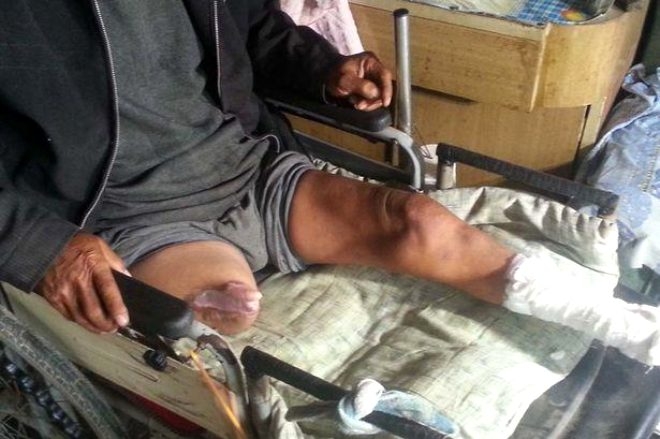 Hastane masraflarını ödeyemeyince, kendisini testereyle ameliyat etti! galerisi resim 1