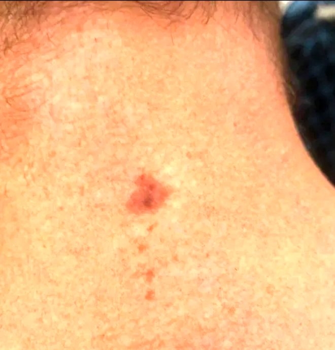 Küçük bir ben tanesi deyip geçmeyin! Sırtından koca parçayı götürdü galerisi resim 2