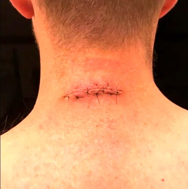 Küçük bir ben tanesi deyip geçmeyin! Sırtından koca parçayı götürdü galerisi resim 3