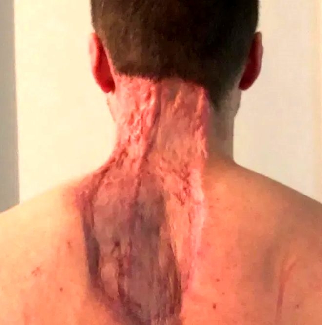 Küçük bir ben tanesi deyip geçmeyin! Sırtından koca parçayı götürdü galerisi resim 5