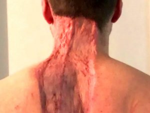 Küçük bir ben tanesi deyip geçmeyin! Sırtından koca parçayı götürdü