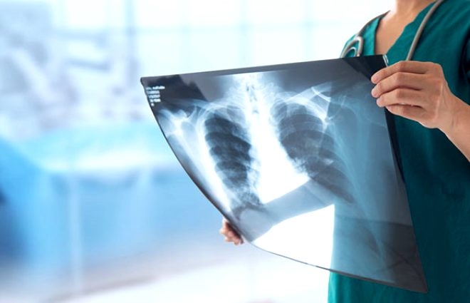 Bu hastalıkları olanlar dikkat! İşte koronavirüste en riskli 11 grup galerisi resim 9