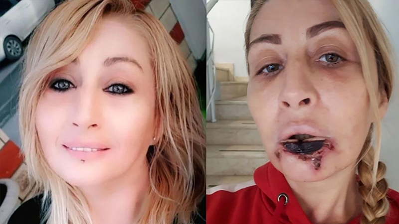 Estetik yaptırdığı dudağı çürüyerek düştü! galerisi resim 1