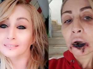 Estetik yaptırdığı dudağı çürüyerek düştü!