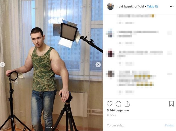 Biceps'e enjekte etti...Kolundan çıkan şoke etti! galerisi resim 1