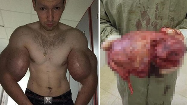 Biceps'e enjekte etti...Kolundan çıkan şoke etti! galerisi resim 12