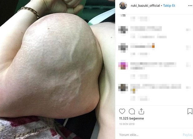 Biceps'e enjekte etti...Kolundan çıkan şoke etti! galerisi resim 5