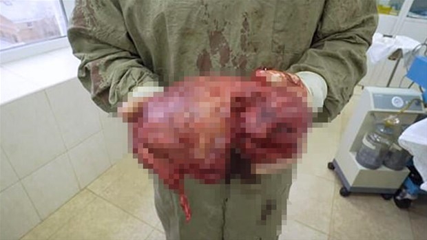 Biceps'e enjekte etti...Kolundan çıkan şoke etti! galerisi resim 7