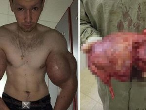 Biceps'e enjekte etti...Kolundan çıkan şoke etti!
