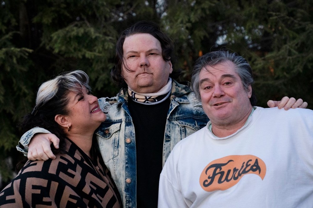 Dünyanın ilk başarılı eş zamanlı yüz ve çift el nakli operasyonu galerisi resim 3