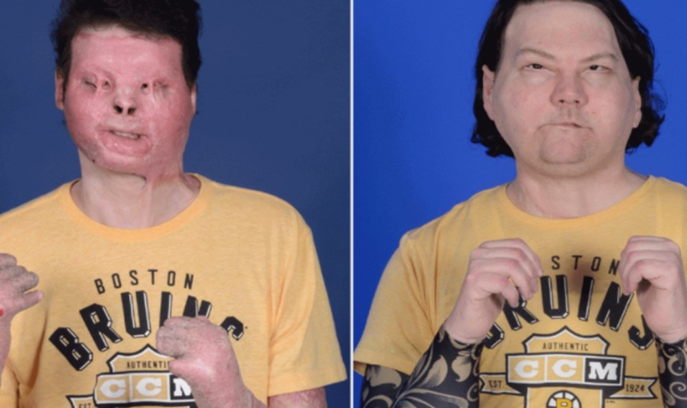 Dünyanın ilk başarılı eş zamanlı yüz ve çift el nakli operasyonu galerisi resim 7