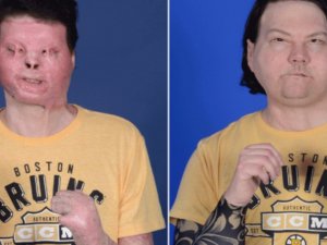 Dünyanın ilk başarılı eş zamanlı yüz ve çift el nakli operasyonu