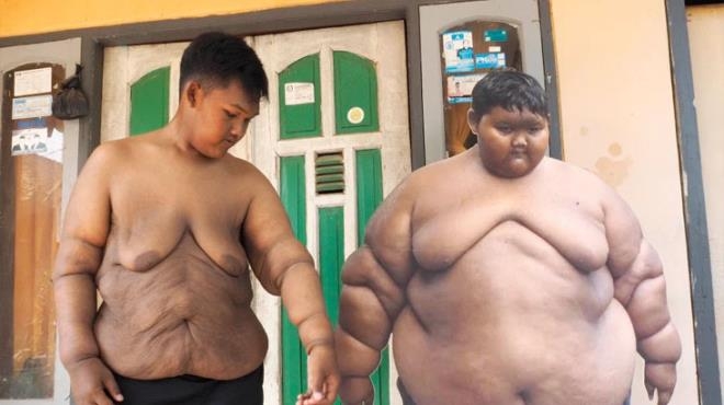 Dünyanın en şişman çocuğu 110 kilo verdi galerisi resim 5