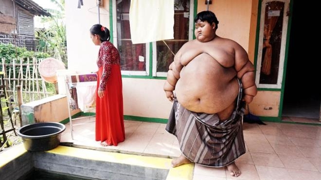 Dünyanın en şişman çocuğu 110 kilo verdi galerisi resim 7
