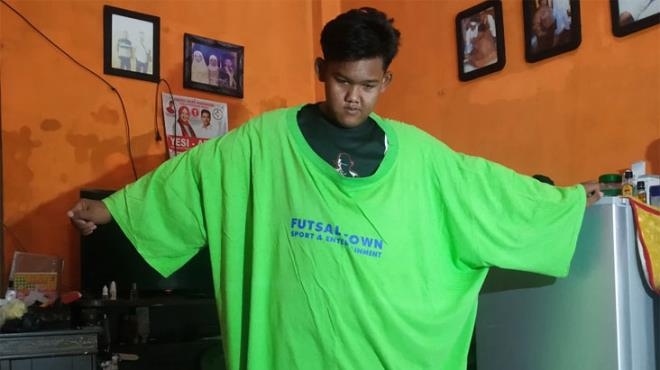 Dünyanın en şişman çocuğu 110 kilo verdi galerisi resim 9