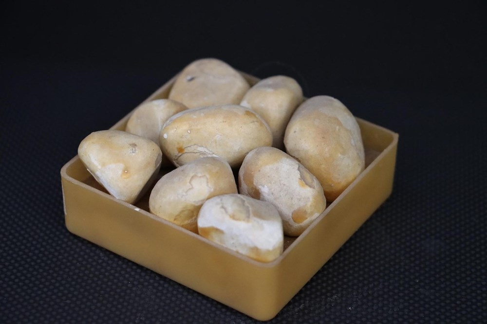 Doktorun ilginç 'taş' koleksiyonu: 2 bin ameliyattan çıkardı galerisi resim 1