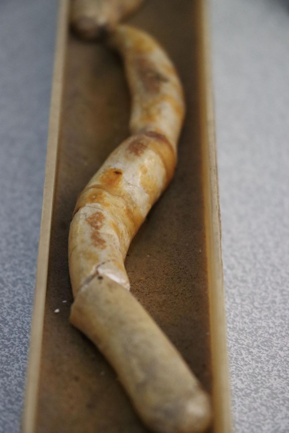 Doktorun ilginç 'taş' koleksiyonu: 2 bin ameliyattan çıkardı galerisi resim 6