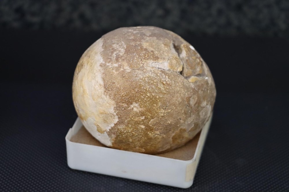 Doktorun ilginç 'taş' koleksiyonu: 2 bin ameliyattan çıkardı galerisi resim 7