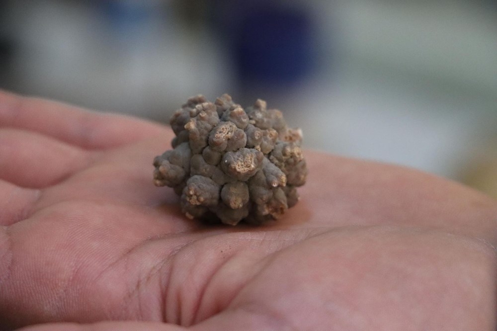 Doktorun ilginç 'taş' koleksiyonu: 2 bin ameliyattan çıkardı galerisi resim 8