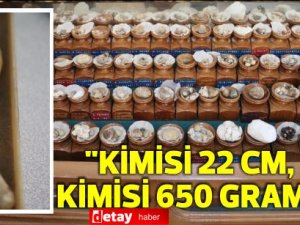 Doktorun ilginç 'taş' koleksiyonu: 2 bin ameliyattan çıkardı