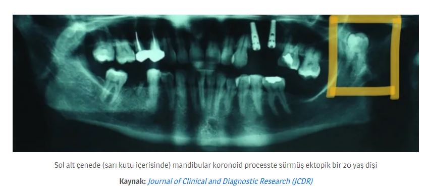 Dişler Yalnızca Ağızda Oluşmuyor! galerisi resim 7