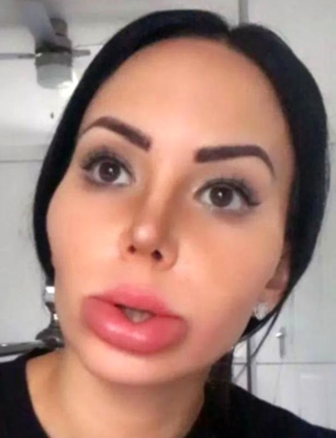 11 YILDA 28 KEZ ESTETİK AMELİYAT OLDU! DÖNÜŞÜMÜ İNANILMAZ galerisi resim 10