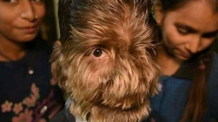 'Kurt adam sendromu'na yakalandı galerisi resim 2