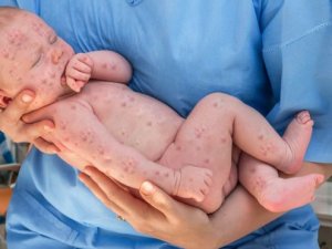 Dünyada kızamık salgınını artıran aşı karşıtı 8 yanlış bilgi