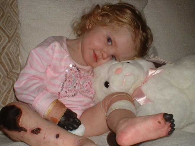 15 aylıkken ellerini kaybetmişti, şimdi makyaj bile yapıyor galerisi resim 1