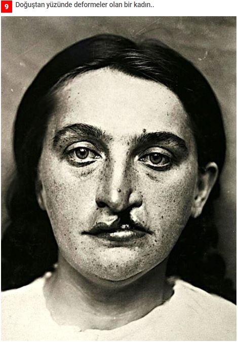 19.yüzyıldan'dan arşivdeki hastalık fotoğrafları galerisi resim 6