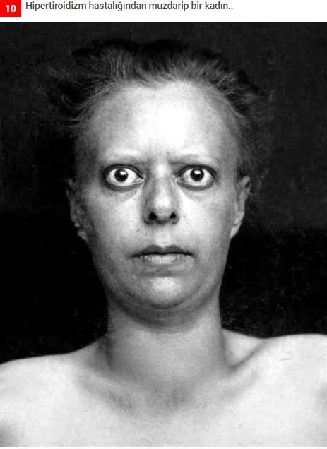 19.yüzyıldan'dan arşivdeki hastalık fotoğrafları galerisi resim 7