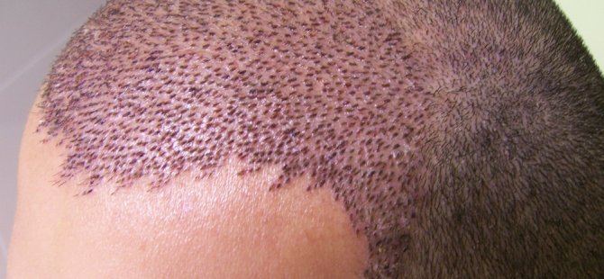 Saç Ekimi Öncesi Bunlara Dikkat !