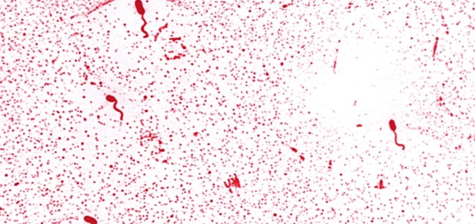 'Vibrio' bakterisi nedir, nasıl bulaşır?