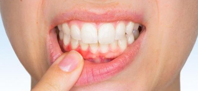 Diş etindeki renk değişikliği neyin belirtisi?