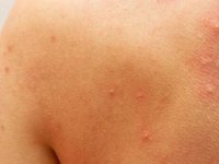 Gece artıp 24 içinde kaybolan kaşıntı hangi hastalığın belirtisi?