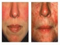 Gül Hastalığı'nda Kadınlar Erkeklere Göre Daha Fazla Etkilenmekte